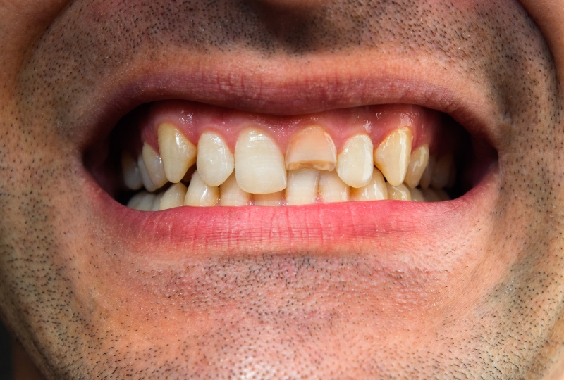 Causes and Tips for Treating Emergency Fractured Teeth